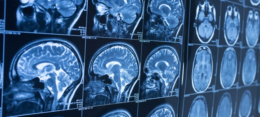 Medical photos of brain scan