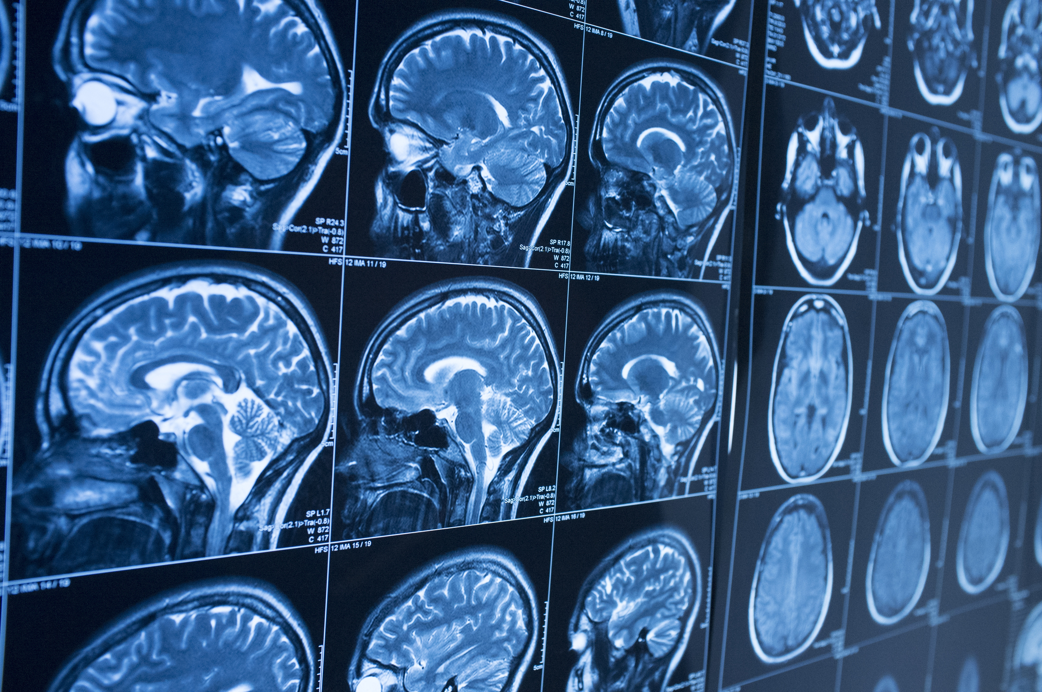 Can brain scans predict relapse?